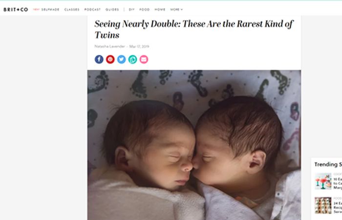 Screenshot of an article - Seeing nearly double: These are the rarest kind of twins.